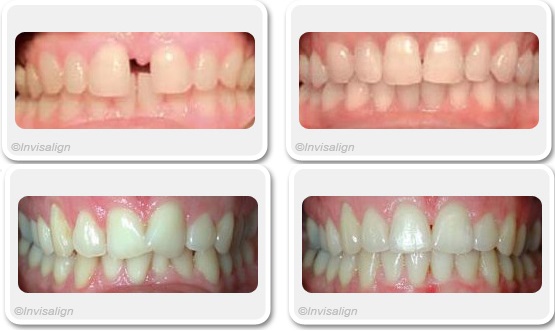 system Invisalign Correctness of occlusion at Rond Point