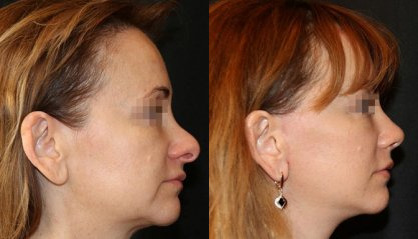 Rhinoplasty przed i po