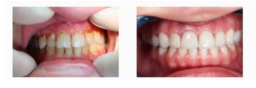 Licówki zainstalowane w Dental Dynastia 