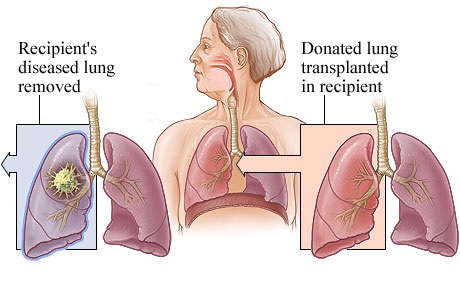 Lung transplantat scheme