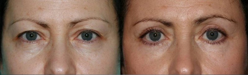Pacjent po blefaroplastyce Pacjent po blefaroplastyce