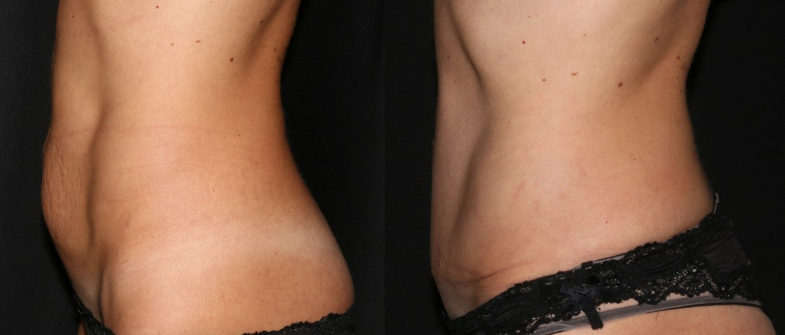 Pacjent po abdominoplastyce Pacjent po abdominoplastyce