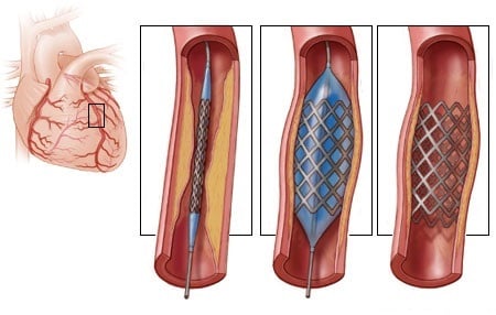Installation of coronary stent