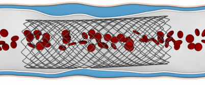 Stenting scheme