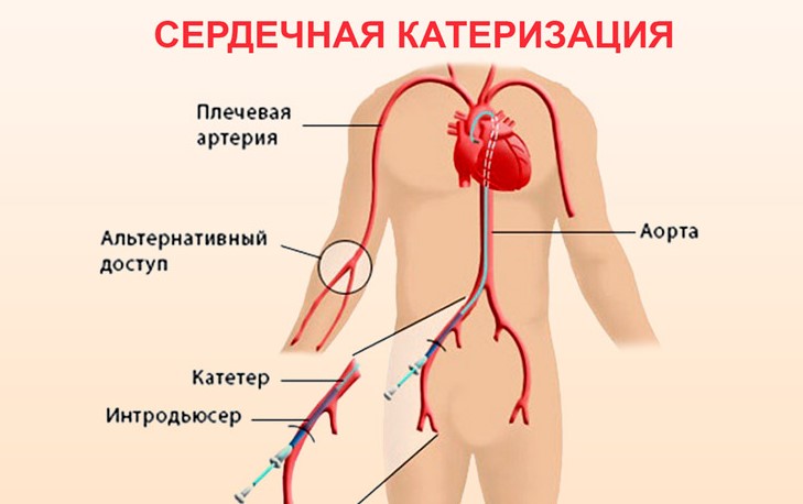 Cardiac catheterization Катетеризация сердца